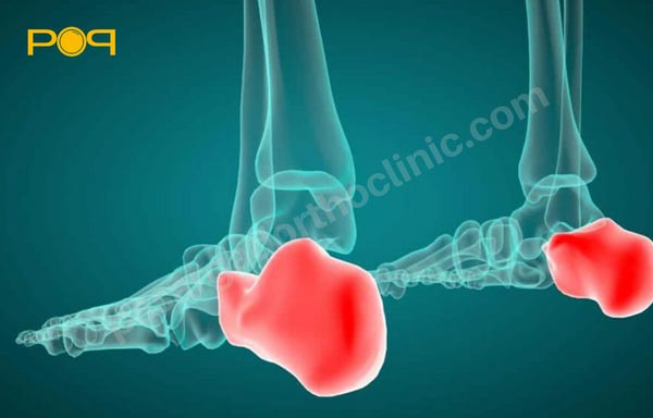 فاسیای کف پا یا Plantar fasciitis