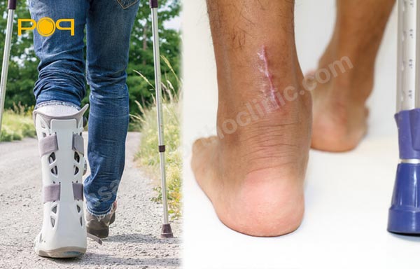 استفاده از ارتزها برای تاندونیت آشیل