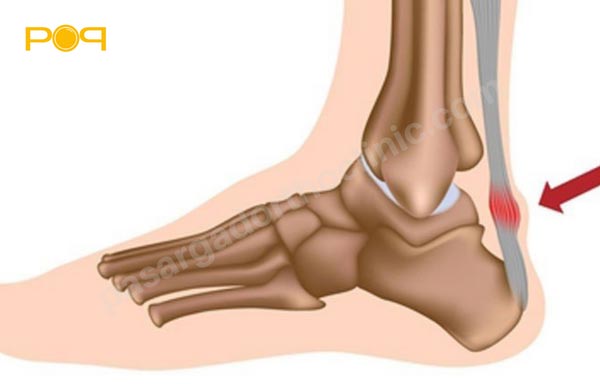 تاندونیت آشیل