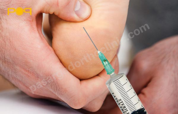 تزریق کورتیکواستروئید در خارپاشنه