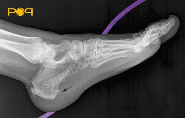 تصویربرداری از خارپاشنه