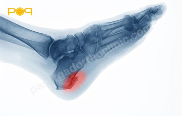 ریسک فاکتورهای بیماری خار پاشنه