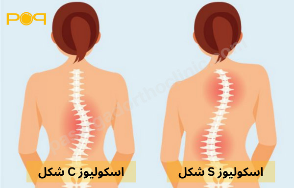 اسکولیوز حالت S و C