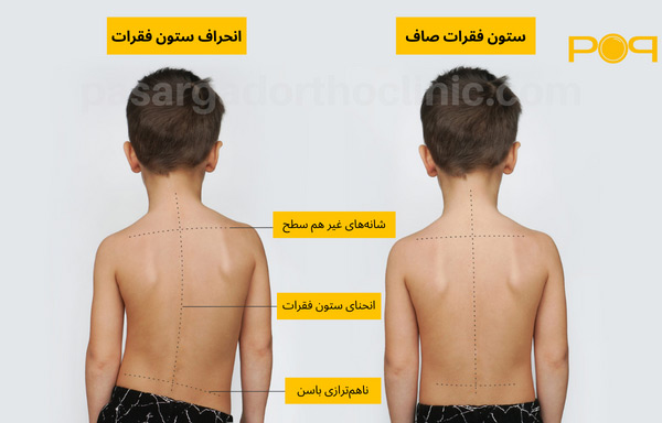 علائم انحراف ستون فقرات