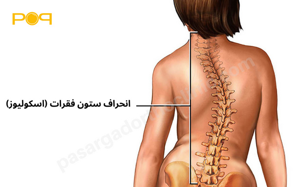 انحراف ستون فقرات (اسکولیوز)