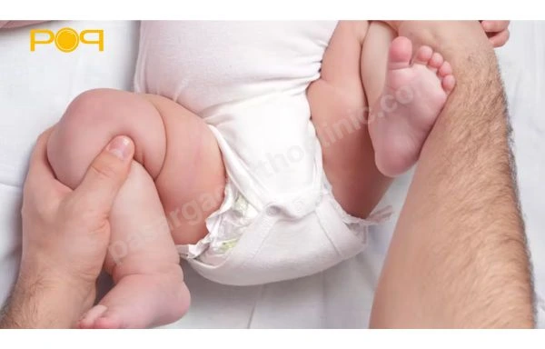چیستی، علائم، علل بروز و روش تشخیص دررفتگی مادرزادی لگن (DDH) (دیسپلازی تکاملی لگن)